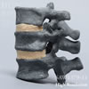 X線ファントム靭帯付き骨粗鬆症胸椎（T10-T12）
